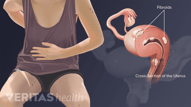 Medical illustration of fibroids
