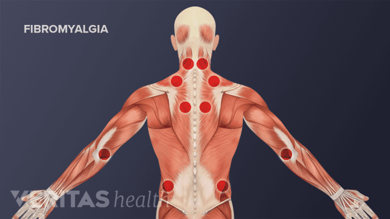 Illustration showing posterior view of torso with trigger points in red.