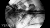 Fluoroscopy radiofrequency needle alongside the medial nerves.