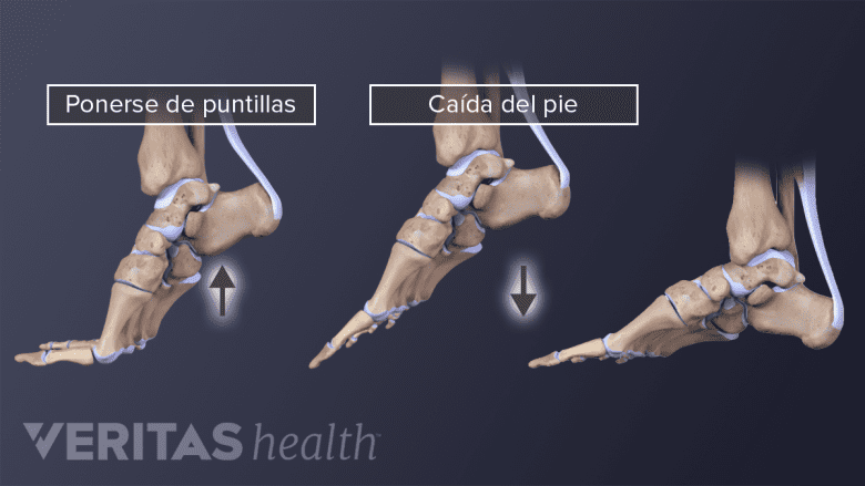 Caída del pie.