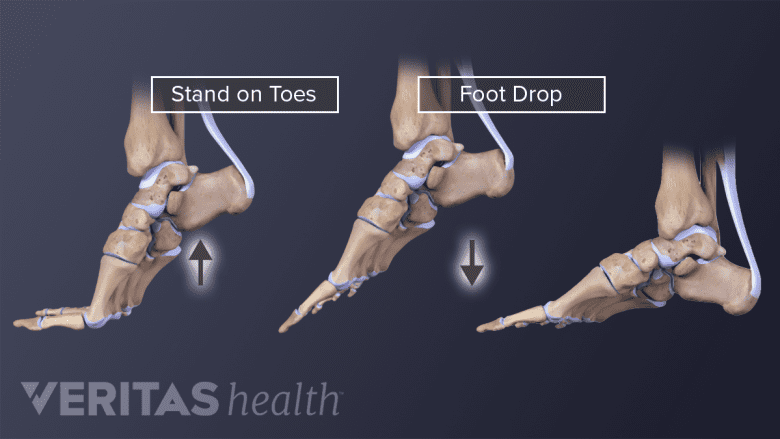 Foot drop and foot weakness in sciatica.