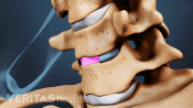 Anterior view of the cervical spine with artificial disc in between two vertebrae.