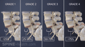 Four grades of degenerative spondylolisthesis