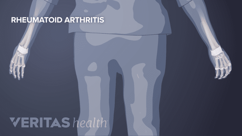 Illustration showing rheumatoid arthritis.