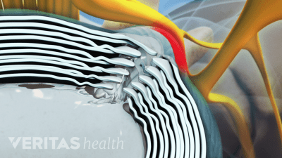 Medical illustration showing a leaking herniated disc which causes a pinched nerve