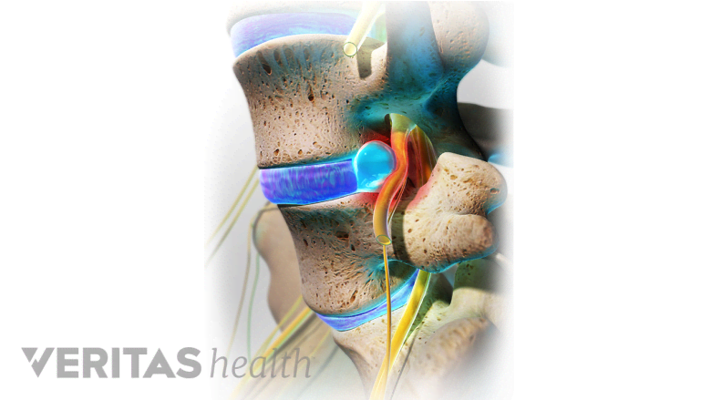 An illustration showing lumbar herniated disc.