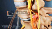 Profile view of a herniated disc in between two vertebrae in the lumbar spine