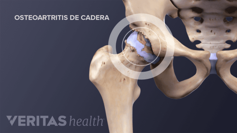 Osteoartritis de la cadera.