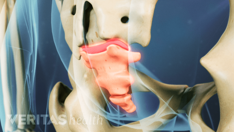 An illustration showing inflammation in the ligament.