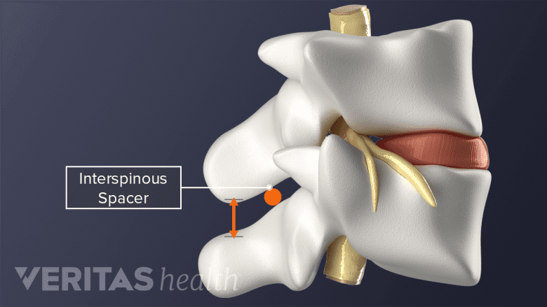 Side view 3D image depicting the application spot of an interspinous process spacer.