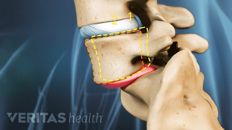 Illustration showing isthemic spondylolisthesis.
