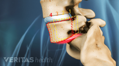 isthmic spondylolisthesis grades
