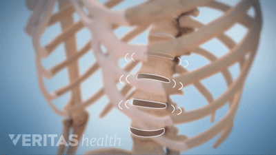 Medical illustration of the lumbar spine showing movement between the vertebrae which often leads to crepitus