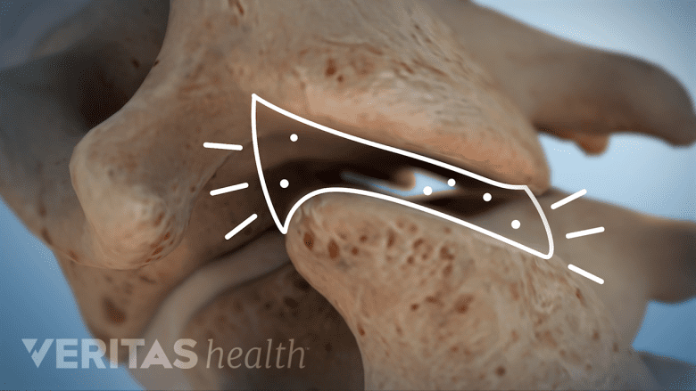 An illustration showing facet joint cracking.