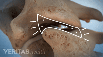Illustration of gas bubbles in a joint capsule of the cervical spine