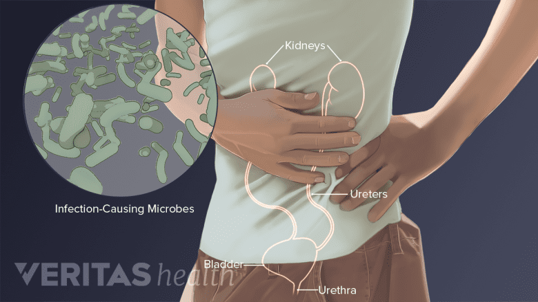 Medical illustration of kidney infection