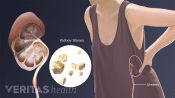 Medical illustration of kidney stones
