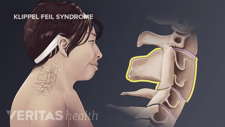 Medical illustration of klippel feil syndrome