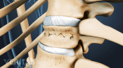 Close up medical illustration of a vertebrae with a compression fracture