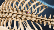 Posterior view of thoracic spine showing kyphoplasty.