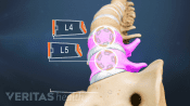 Medical illustration of the spine. The L4 and L5 vertebrae are highlighted.