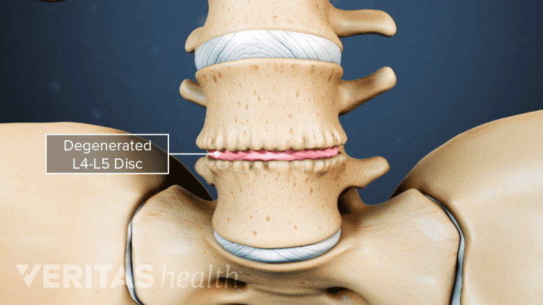 Anterior 3D view of the spine with a labeled degenerated L4-L5 disc.