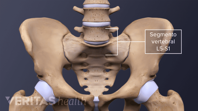 El segmento vertebral L5-S1 en la pelvis.