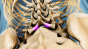 Highlighting the location of a lumbar laminectomy procedure in the lower back.