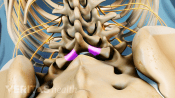 Highlighting the location of a lumbar laminectomy procedure in the lower back.