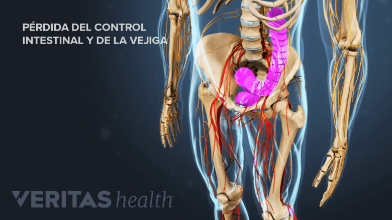 Pérdida del control de la vejiga y intestinal.