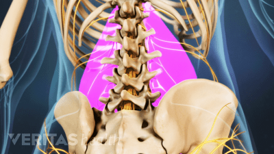 Medical illustration of the lower spine. The muscles are highlighted, to indicate muscle strain