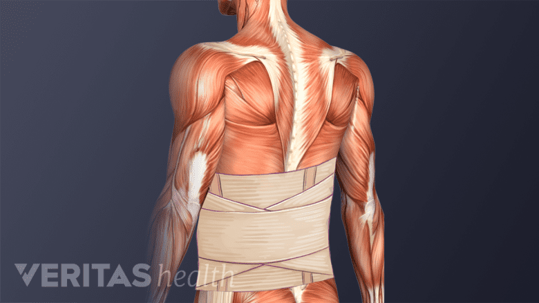 Posterior view of torso with a lumbar brace.