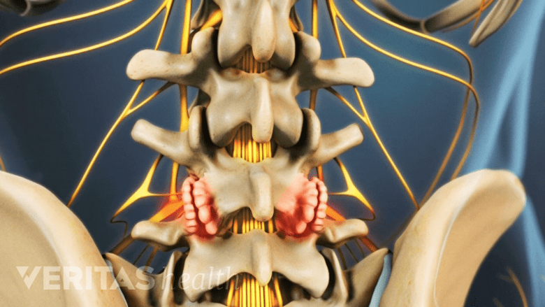 Bone spurs on the facet joints.