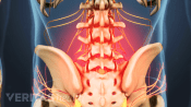Lower back with the pain area caused by lumbar degenerative disc disease higlighted