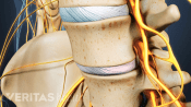 Profile view of degenerative disc disease in the lumbar spine