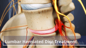 Anterior view of a lumbar herniated disc.