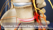 Anterior view of a lumbar herniated disc.