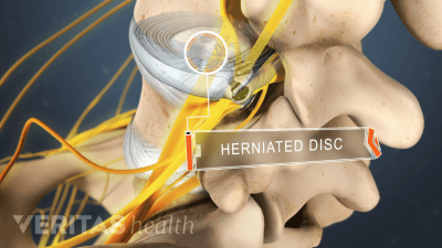 Posterior view labeling a herniated disc in the lumbar spine.