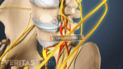 Medical illustration of a herniated disc