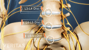 Lumbar spinal implant selection may differ depending on the location of the lumbar spine