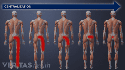 Sciatica and back pain centralization through McKenzie method back exercises.