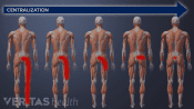 Sciatica and back pain centralization through McKenzie method back exercises.