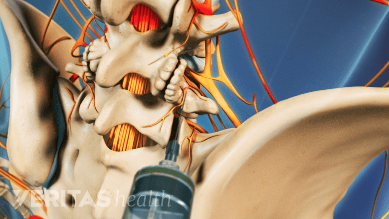 Inyección administrada cerca del nervio espinal al agujero intervertebral.