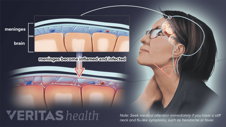 Medical illustration showing meningitis.