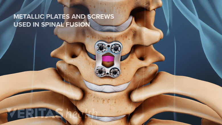 Metallic plates and screws used in a spinal fusion