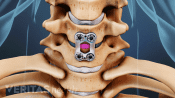 Medical illustration of a plate across two vertebrae from an ACDF surgery.
