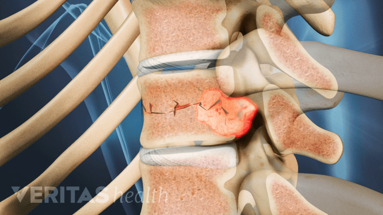 Illustration showing tumor in the vertebra.