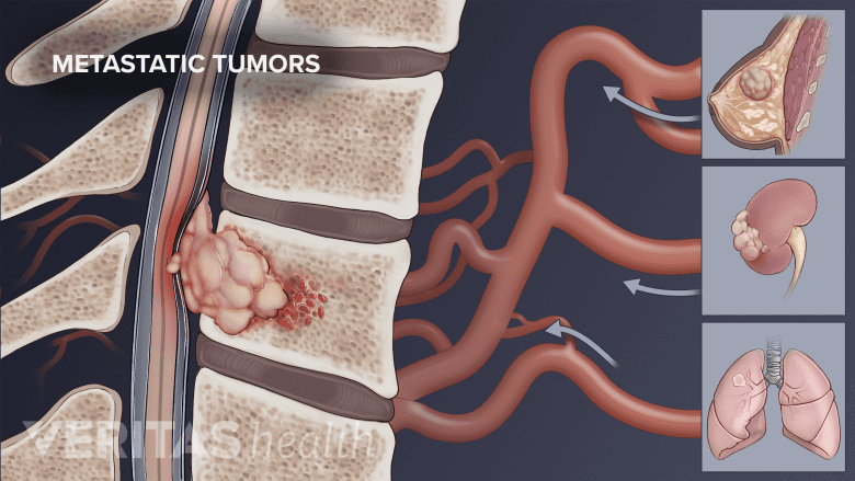 Illustratn showing matastatic tumors from breast, kidney, and lungs  spread to bone.