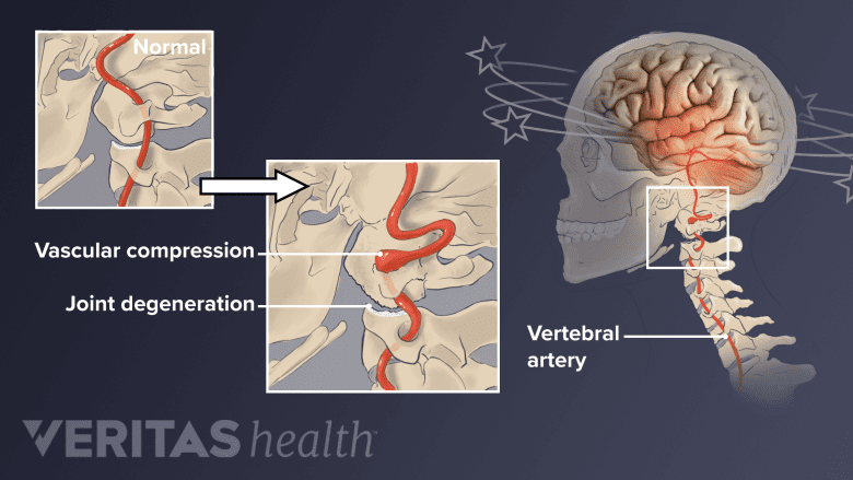 Medical illustration showing dizziness and neck pain.
