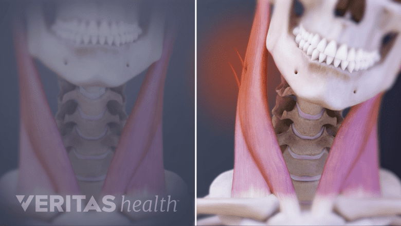 Medical illustration showing neck spasm.